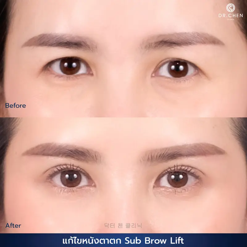 ศัลยกรรมตา