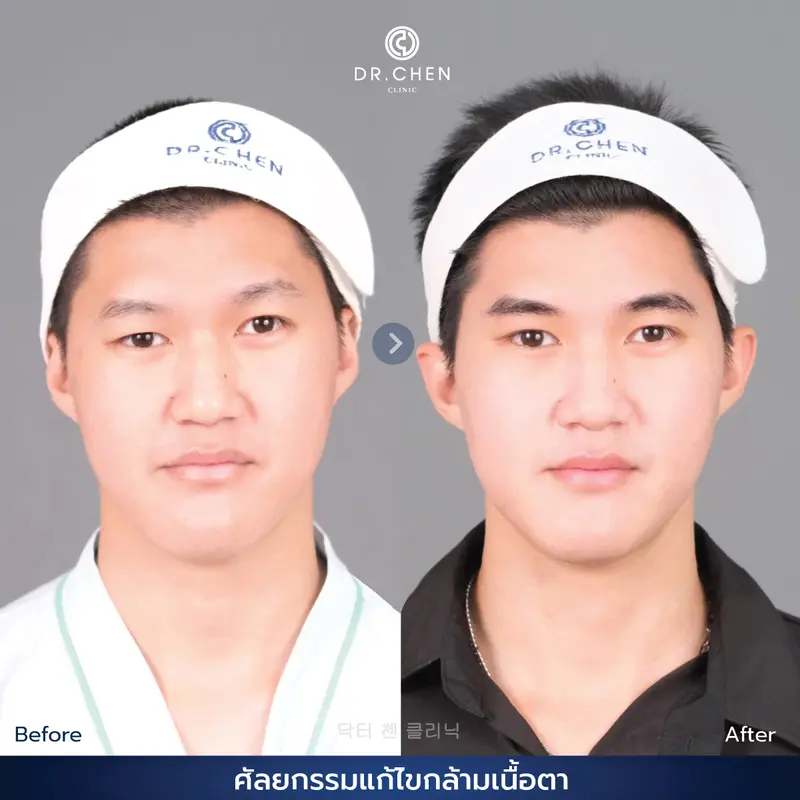 ศัลยกรรมตา