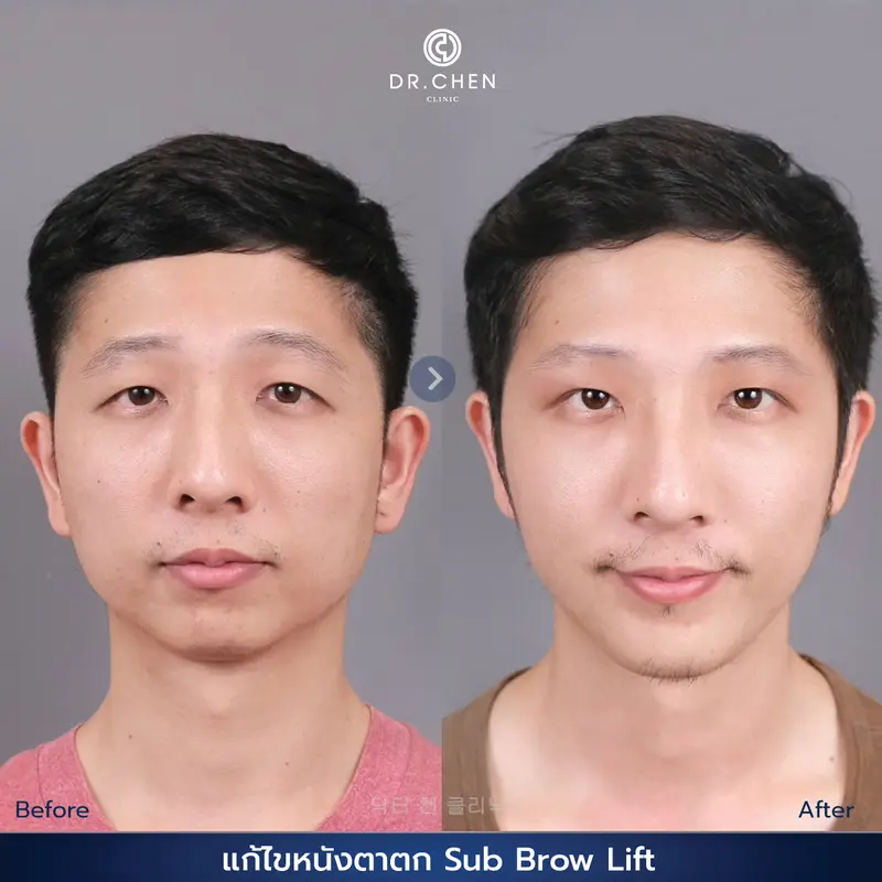 ศัลยกรรมตา