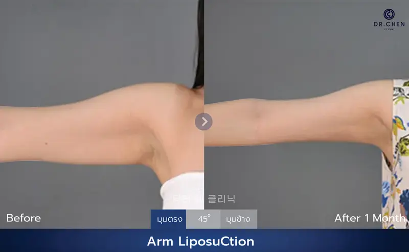 ดูไขมันแขน