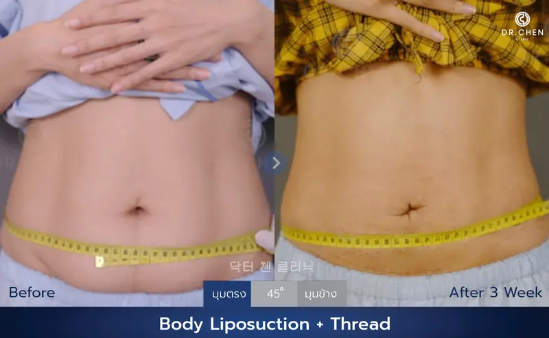 ดูดไขมัน