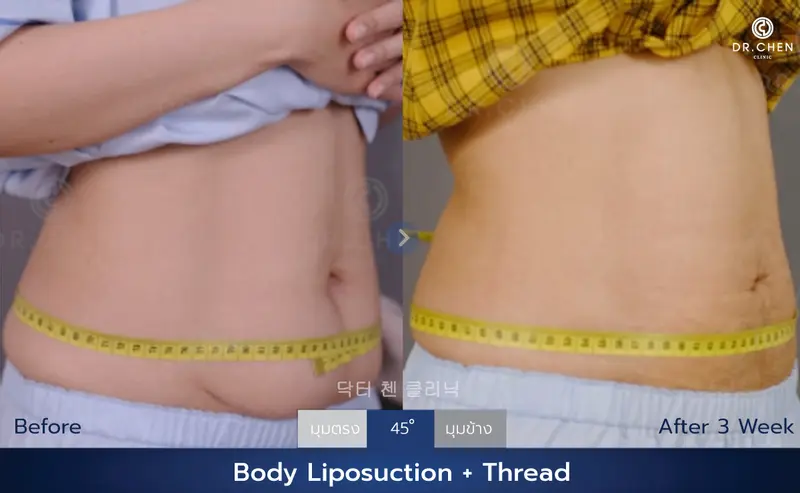 ดูดไขมัน