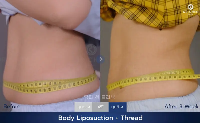 ดูดไขมัน