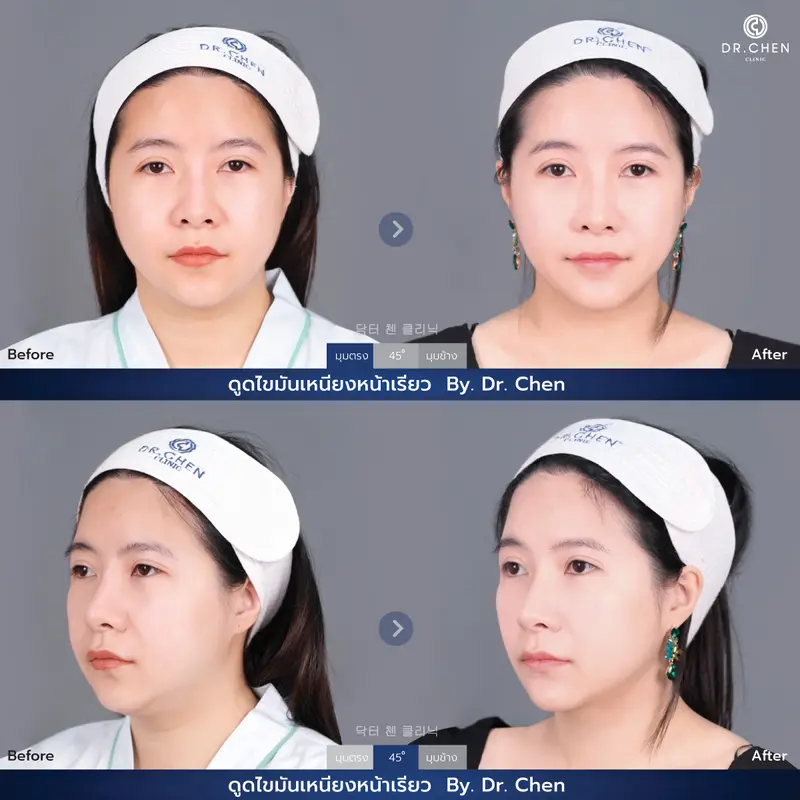 ดูดไขมันเหนียง