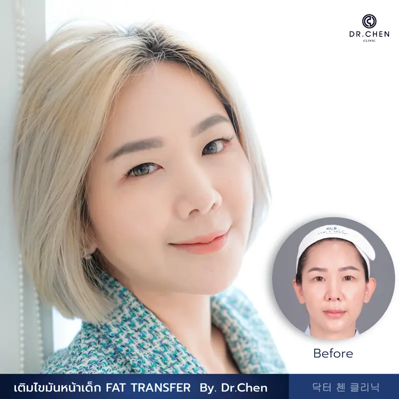 เติมไขมันหน้าเด็ก FAT TRANSFER 