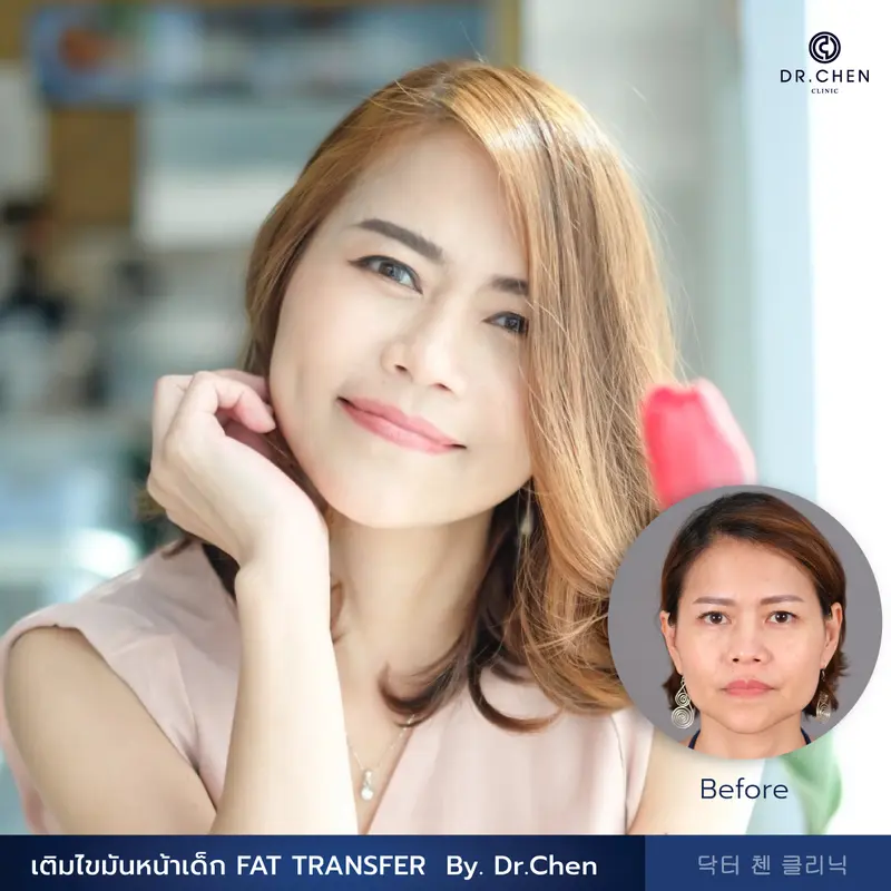 เติมไขมันหน้าเด็ก FAT TRANSFER 