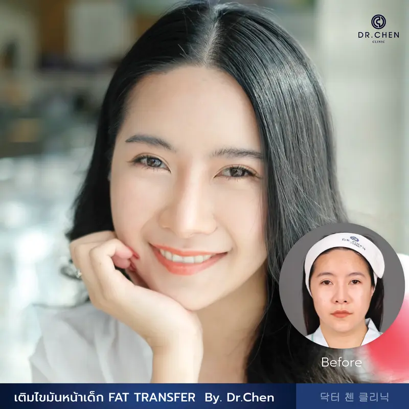 เติมไขมันหน้าเด็ก FAT TRANSFER 