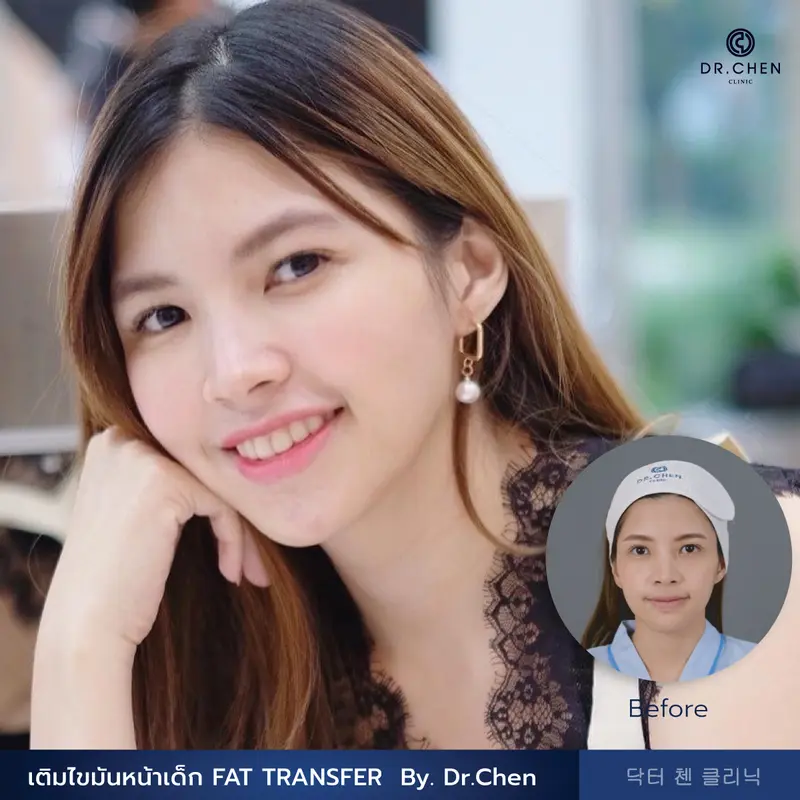 เติมไขมันหน้าเด็ก FAT TRANSFER 