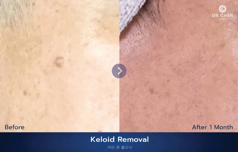 ศัลยกรรมผ่าตัดติ่งเนื้อ