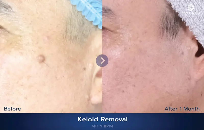 ศัลยกรรมผ่าตัดติ่งเนื้อ