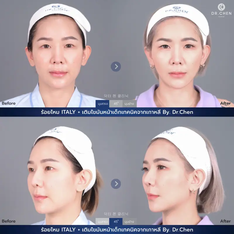 ปรับรูปหน้า