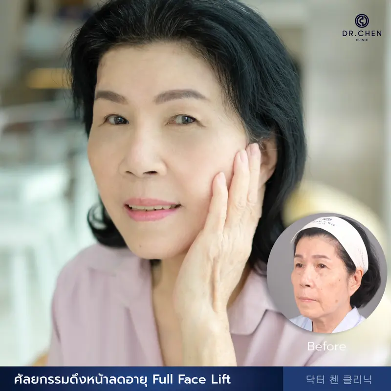 ศัลยกรรมดึงหน้าลดอายุ Full Face Lift
