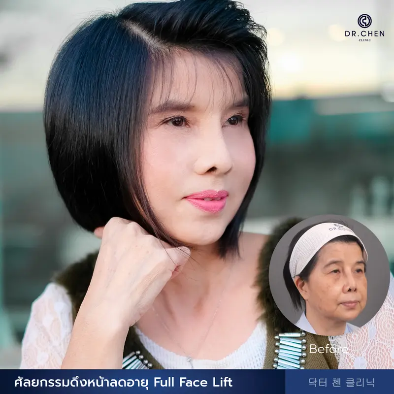 ศัลยกรรมดึงหน้าลดอายุ Full Face Lift