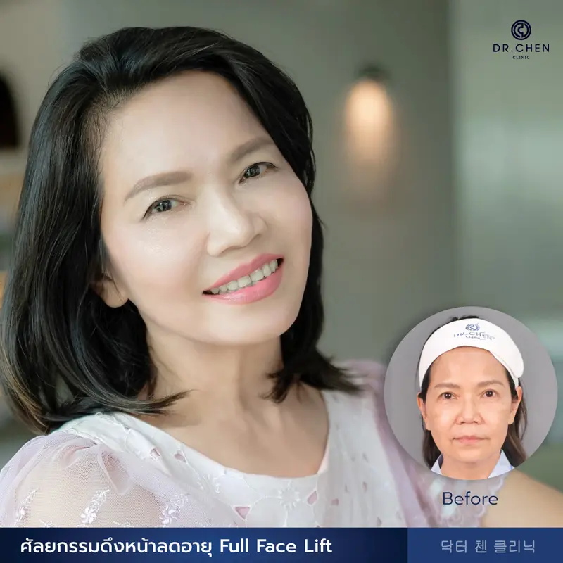 ศัลยกรรมดึงหน้าลดอายุ Full Face Lift
