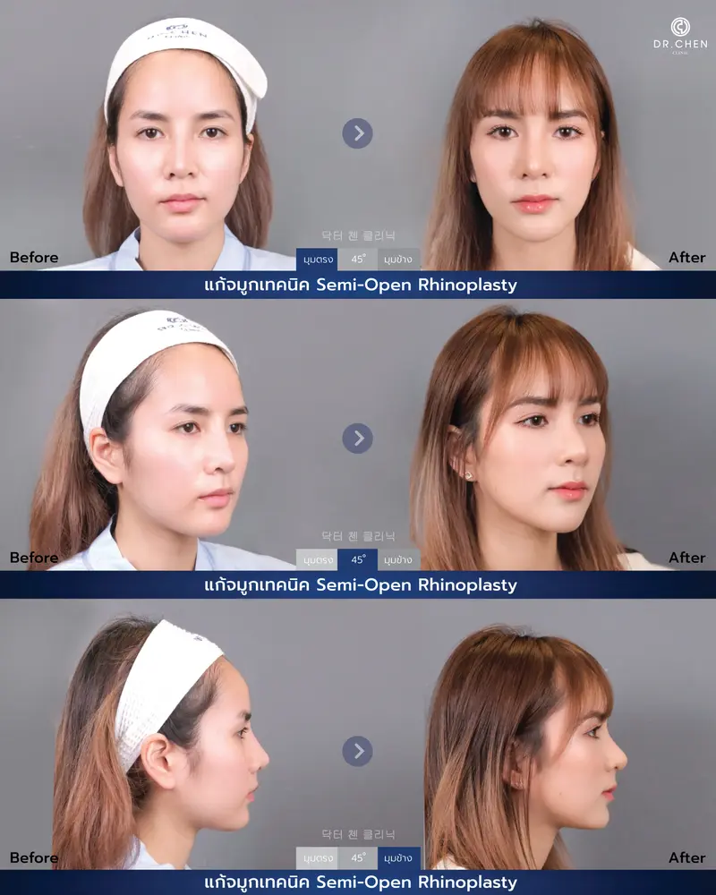 Semi-open rhinoplasty