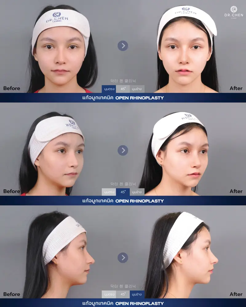 แก้จมูก Rib Rhinoplasty