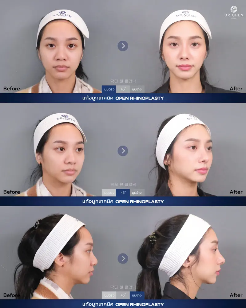 แก้จมูก ติดเชื้อ Open Rhinoplasty