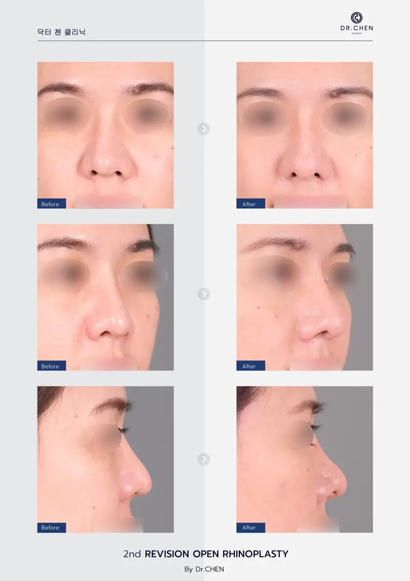 Revision Open Rhinoplasty