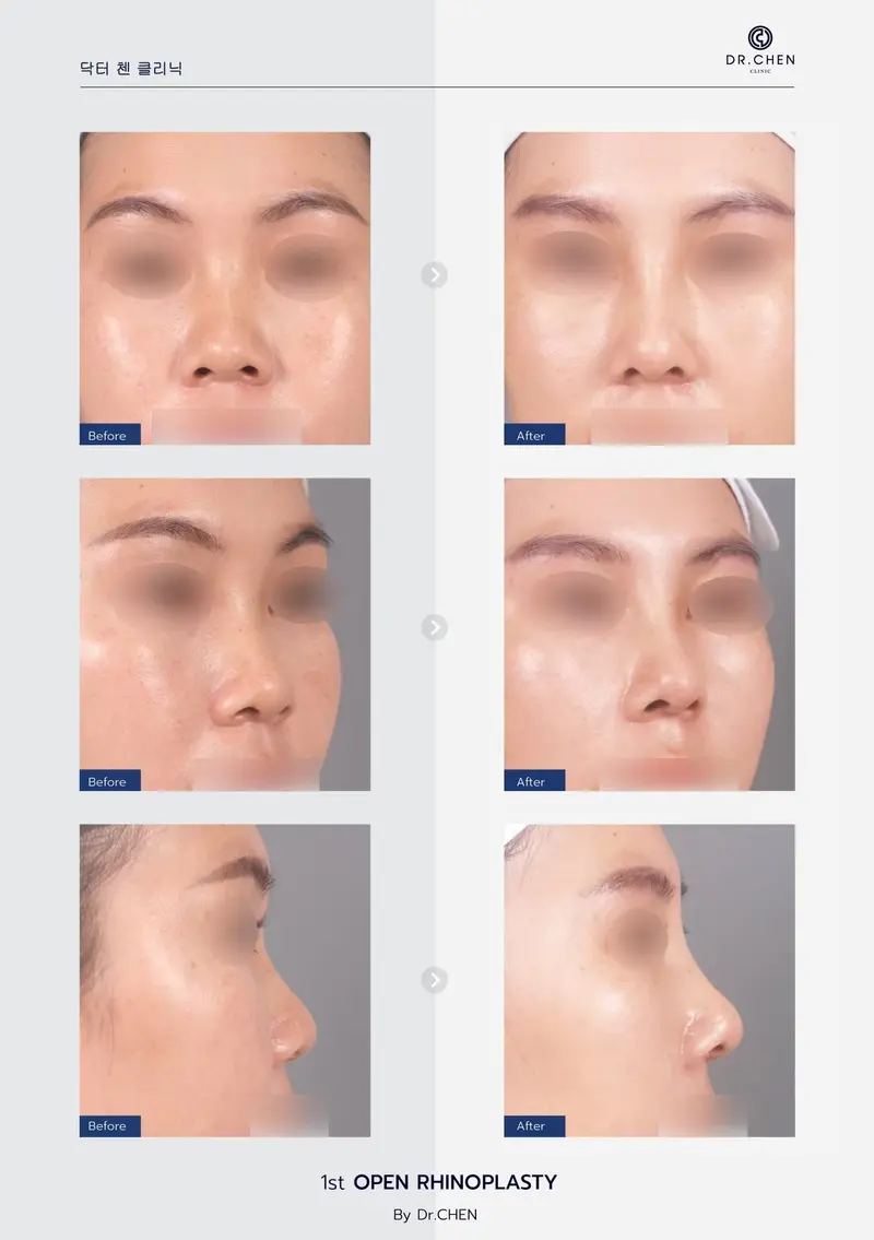 Revision Open Rhinoplasty