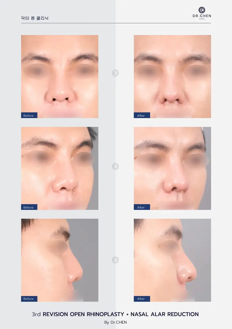 Revision Open Rhinoplasty + Nasal Alar Reduction