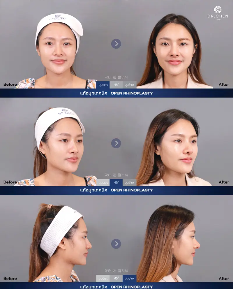 แก้จมูกเทคนิค Open Rhinoplasty
