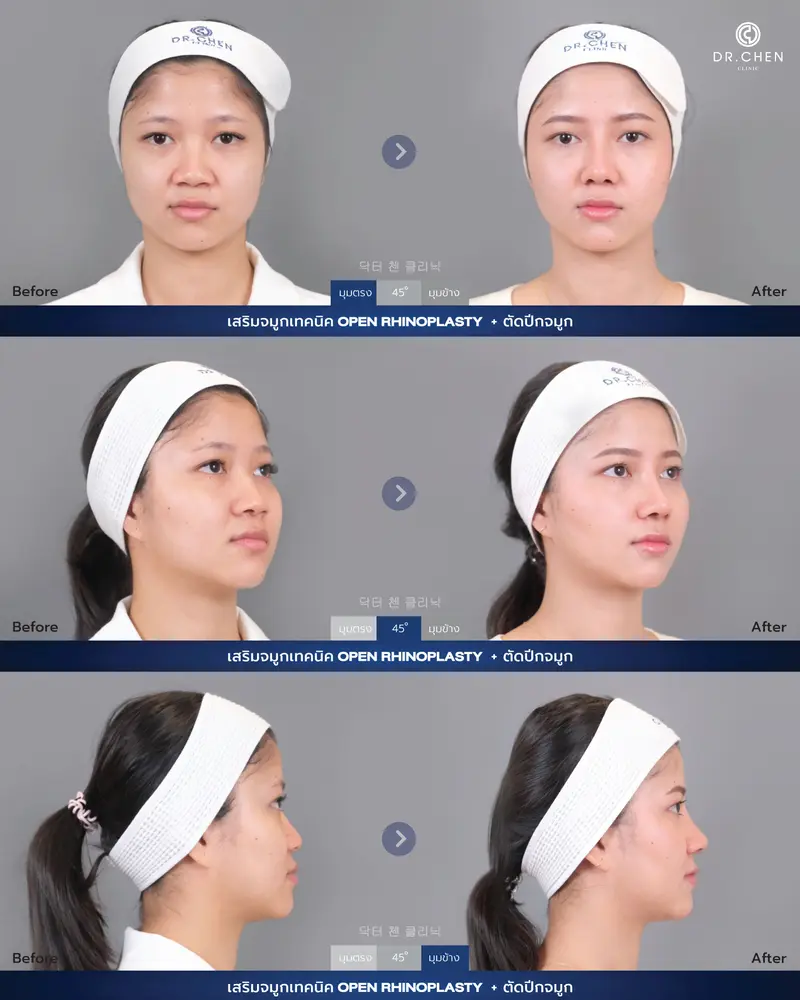 เสริมจมูกเทคนิค Open Rhinoplasty + ตัดปีกจมูก