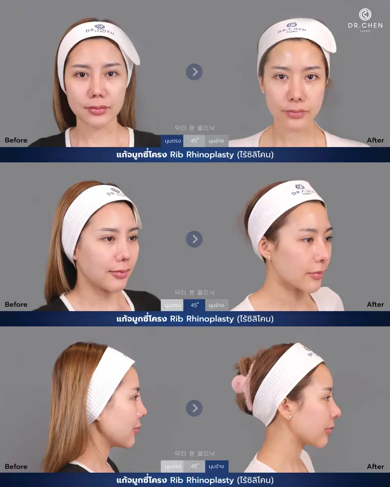 แก้จมูกซี่โครง Rib Rhinoplasty (ไร้ซิลิโคน)