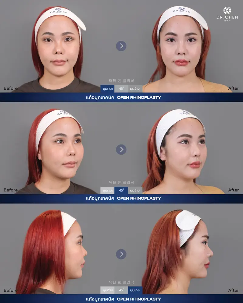 แก้จมูกเทคนิค Open Rhinoplasty