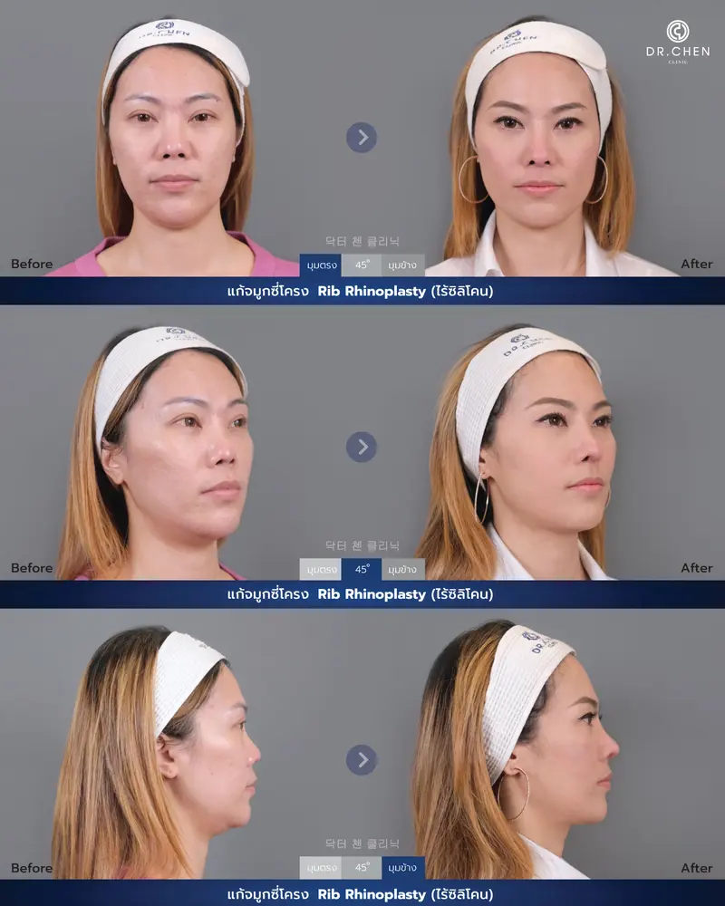 แก้จมูกซี่โครง Rib Rhinoplasty (ไร้ซิลิโคน)