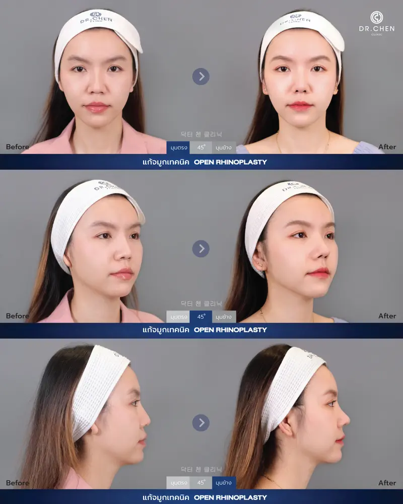 ศัลยกรรมจมูก