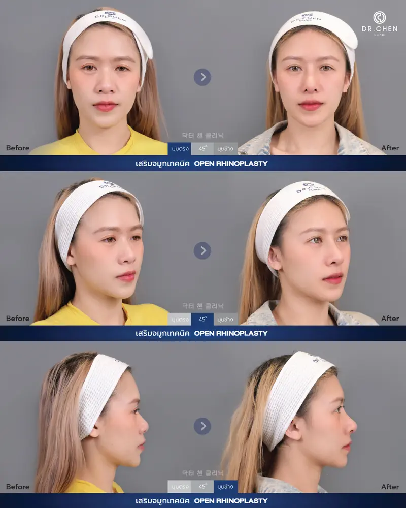 ศัลยกรรมจมูก