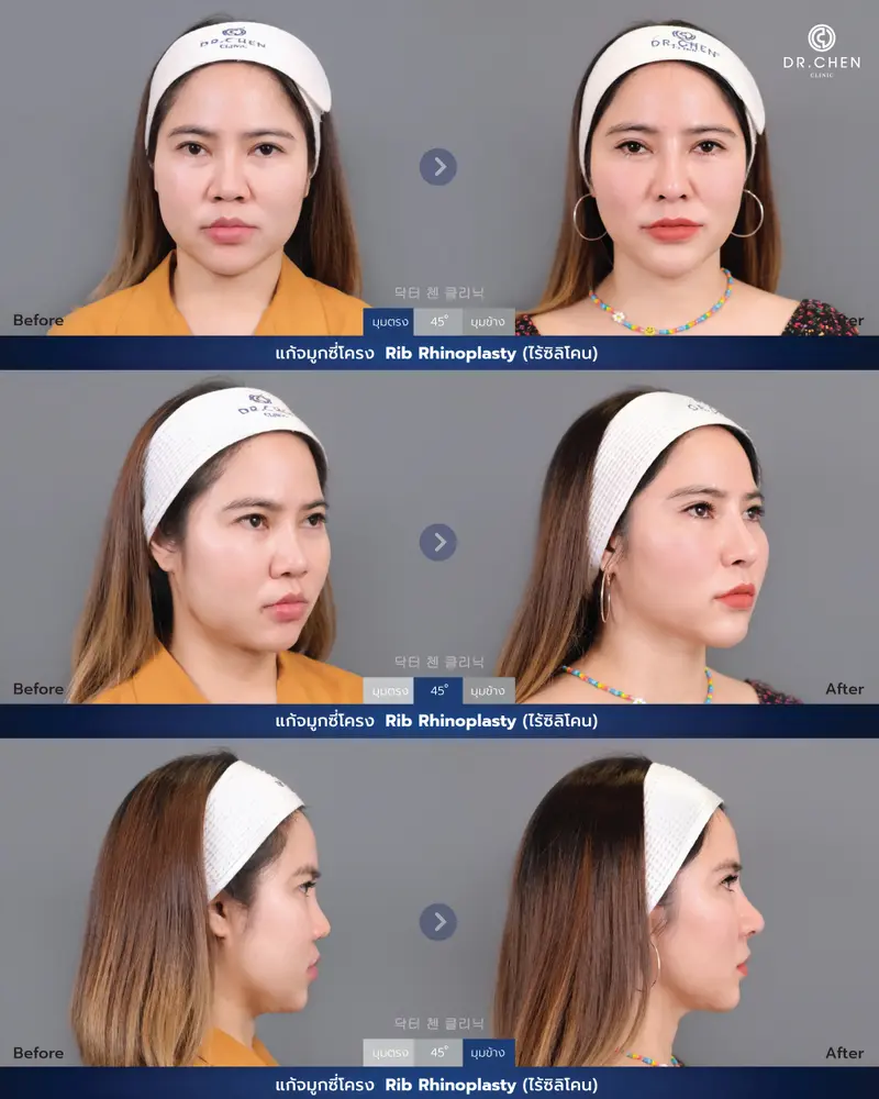 แก้จมูกซี่โครง Rib Rhinoplasty (ไร้ซิลิโคน)