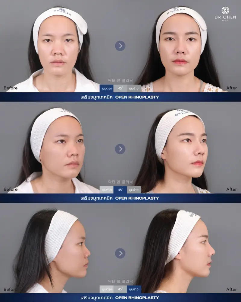 ศัลยกรรมจมูก