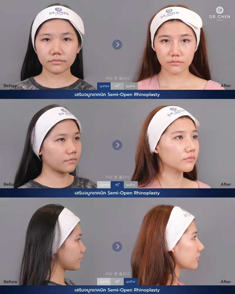 ศัลยกรรมจมูก