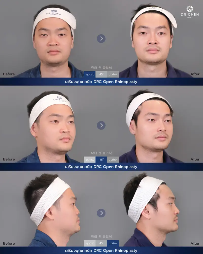 ศัลยกรรมจมูกเทคนิค DRC Open Rhinoplasty