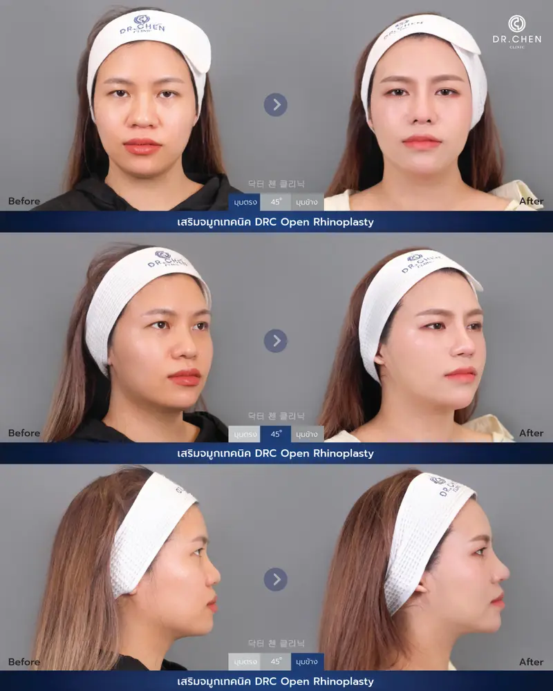 ศัลยกรรมจมูกเทคนิค DRC Open Rhinoplasty