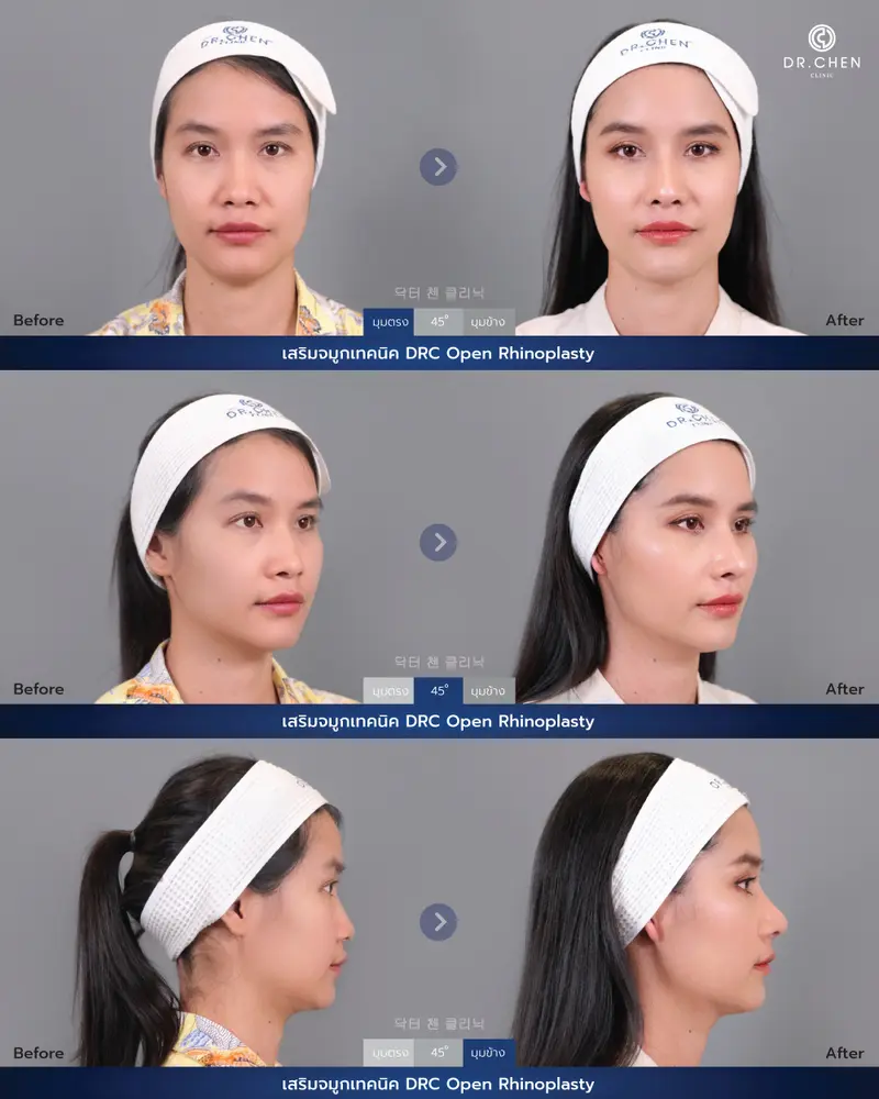 ศัลยกรรมจมูกเทคนิค DRC Open Rhinoplasty