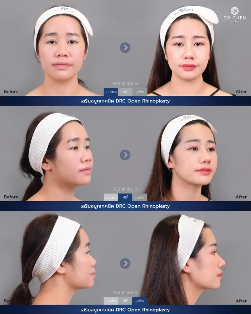 ศัลยกรรมจมูกเทคนิค DRC Open Rhinoplasty