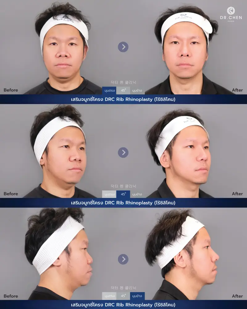 ศัลยกรรมจมูกเทคนิค DRC Rib Rhinoplasty (ไร้ซิลิโคน)