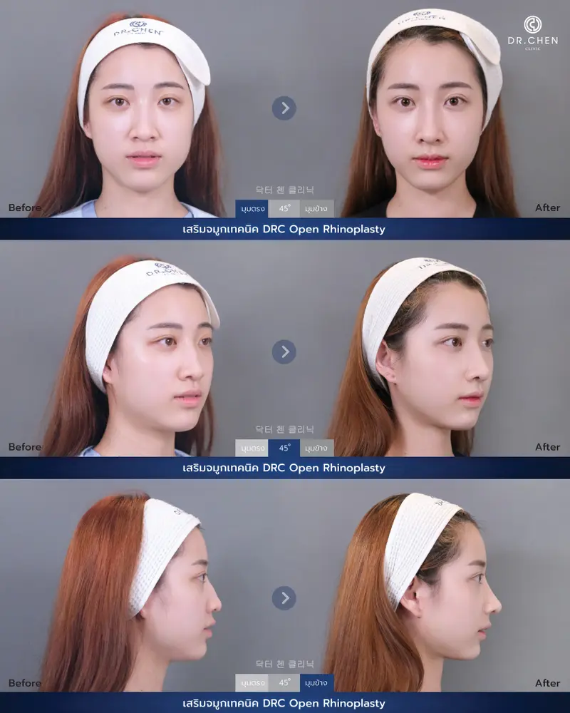 ศัลยกรรมจมูกเทคนิค DRC Open Rhinoplasty