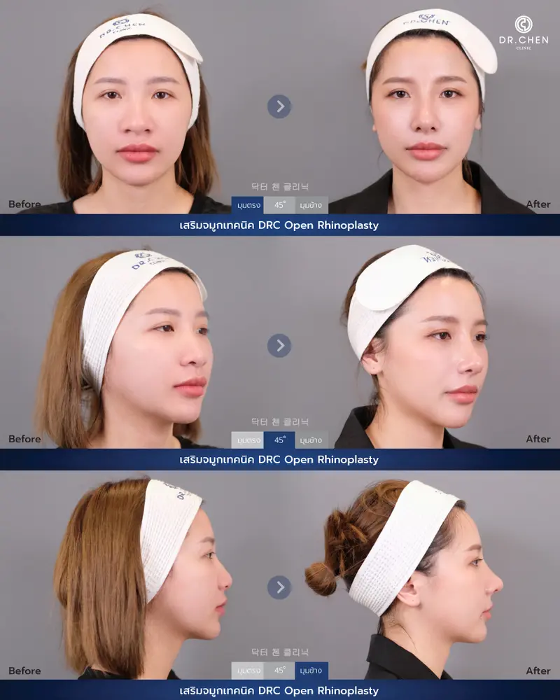 ศัลยกรรมจมูกเทคนิค DRC Open Rhinoplasty