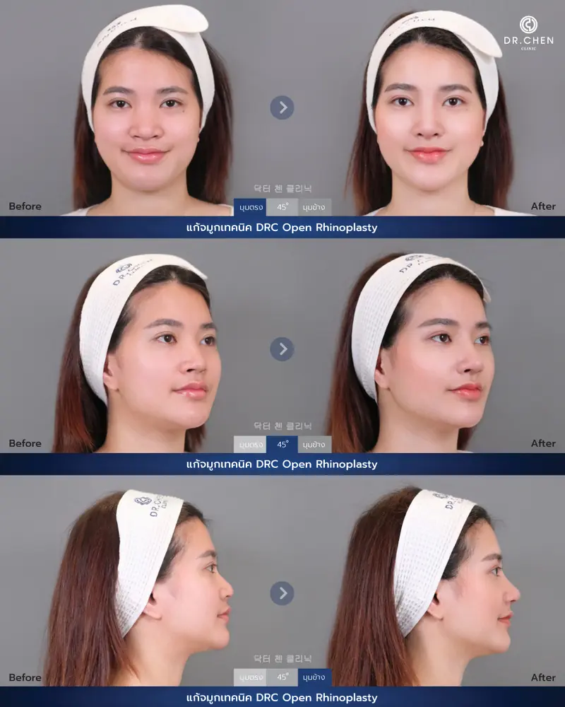 ศัลยกรรมจมูกเทคนิค DRC Open Rhinoplasty