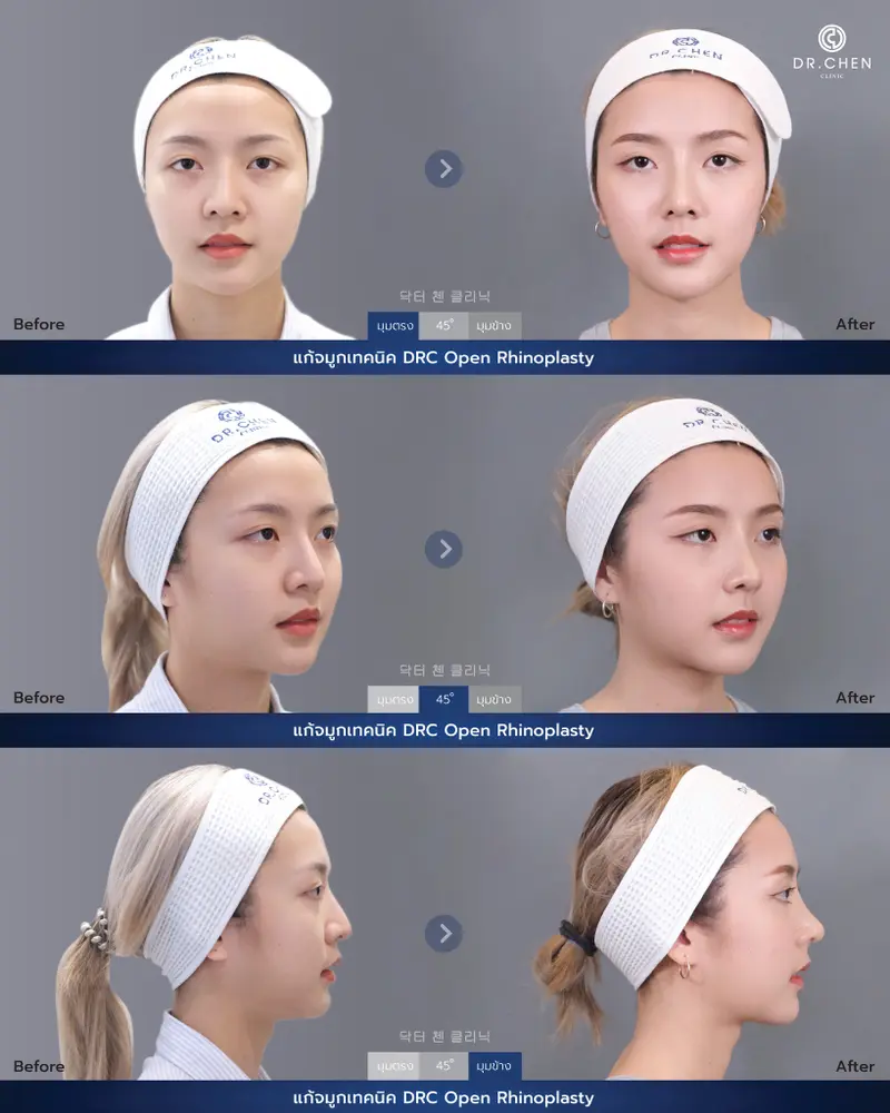 ศัลยกรรมจมูกเทคนิค DRC Open Rhinoplasty
