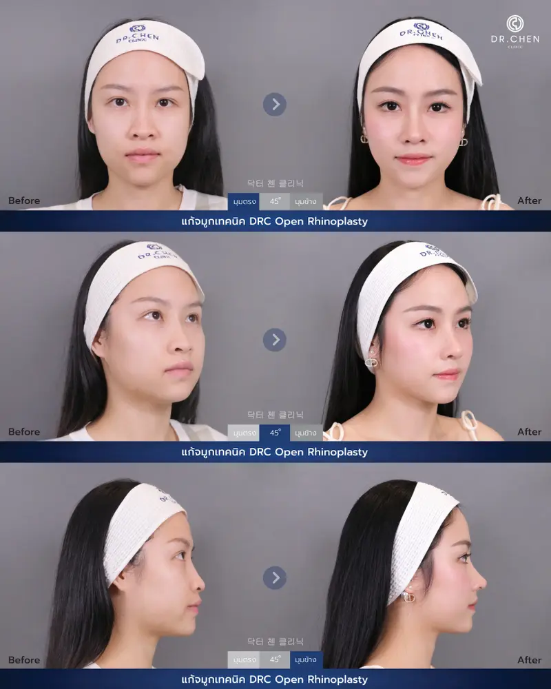 ศัลยกรรมจมูกเทคนิค DRC Open Rhinoplasty