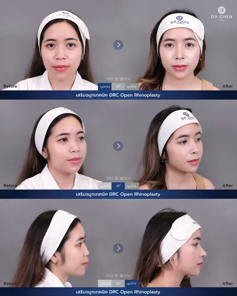 ศัลยกรรมจมูกเทคนิค DRC Open Rhinoplasty