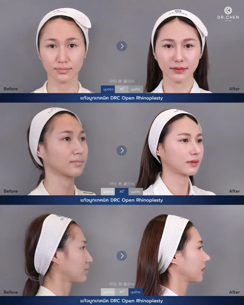 ศัลยกรรมจมูกเทคนิค DRC Open Rhinoplasty