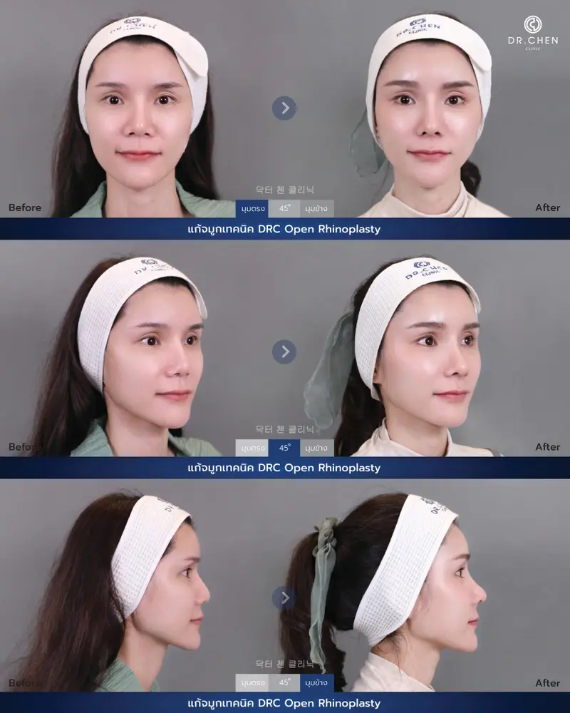 ศัลยกรรมจมูกเทคนิค DRC Open Rhinoplasty
