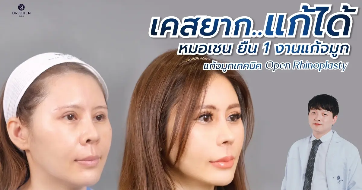 เคสยากแก้ได้ ‼️‼️❤️ แก้จมูกปรับโครงสร้าง ด้วยเทคนิค  DRC Open Rhinoplasty ที่ Dr. Chen Clinic 