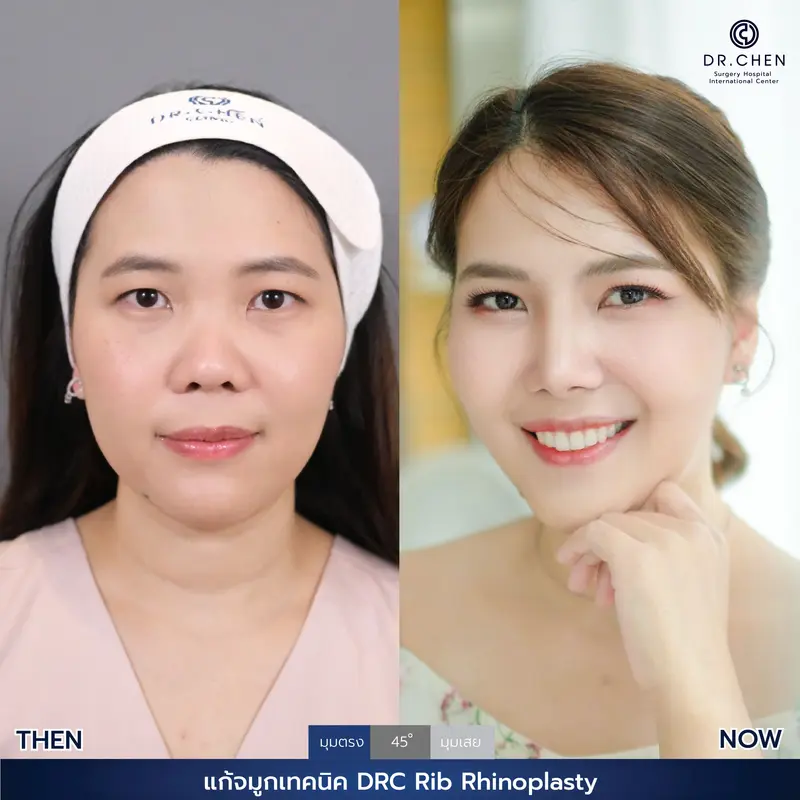 แก้จมูกเทคนิค DRC Rib Rhinoplasty