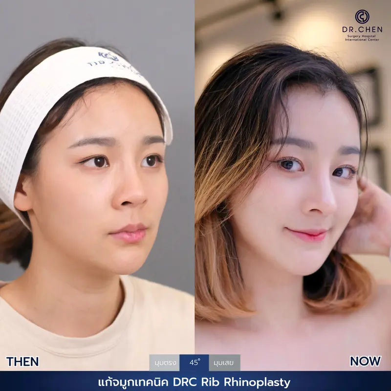 แก้จมูกเทคนิค DRC Rib Rhinoplasty